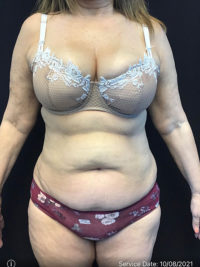 Tummy Tuck