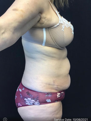 Tummy Tuck