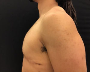 Gynecomastia