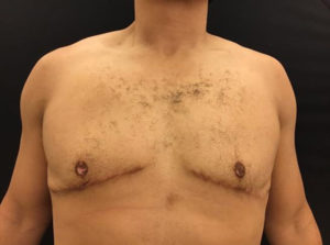 Gynecomastia