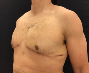 Gynecomastia