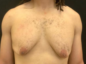 Gynecomastia