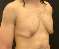 Gynecomastia