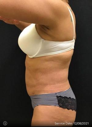 Liposuction