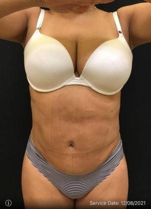 Liposuction