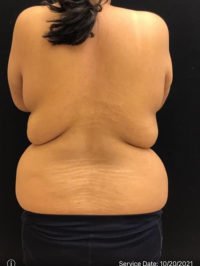 Liposuction