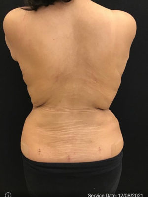 Liposuction