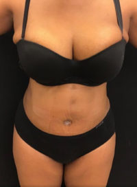 Tummy Tuck