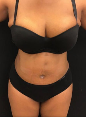 Tummy Tuck