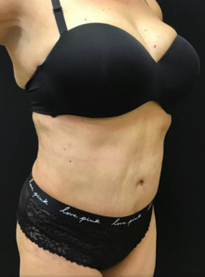 Tummy Tuck