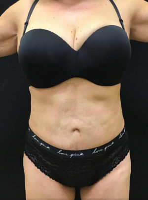 Tummy Tuck