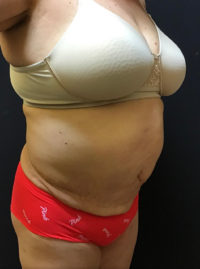 Tummy Tuck