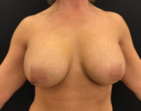 Breast Augmentation