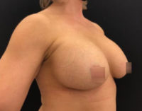 Breast Augmentation