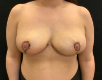 Breast Reduction