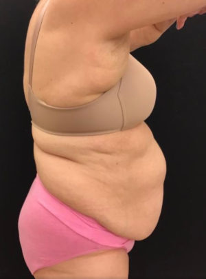 Liposuction