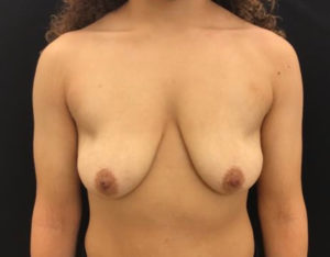 Breast Lift