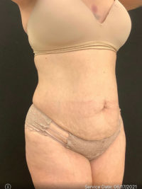 Tummy Tuck