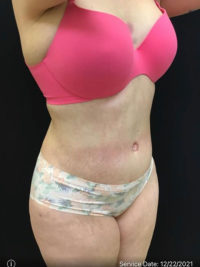 Tummy Tuck