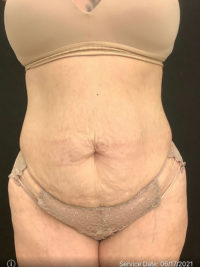 Tummy Tuck