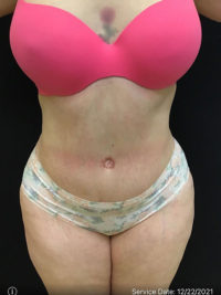 Tummy Tuck