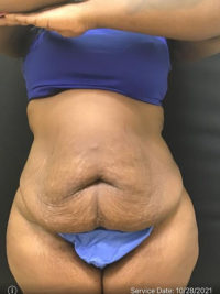 Tummy Tuck