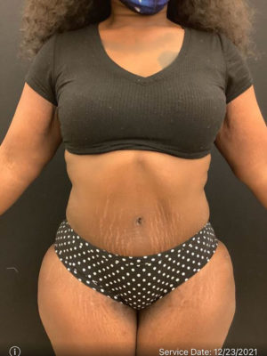 Tummy Tuck