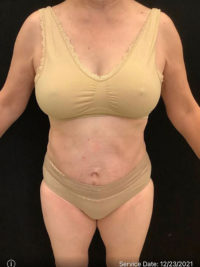 Tummy Tuck