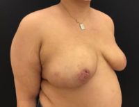 Breast Reduction