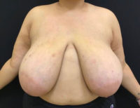 Breast Reduction