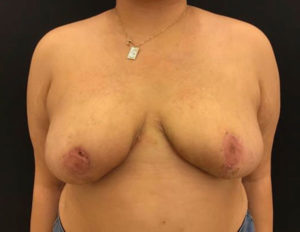 Breast Reduction