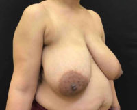 Breast Reduction