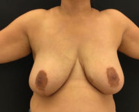 Breast Reduction