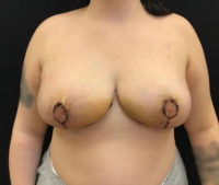 Breast Reduction