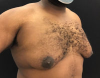 Gynecomastia