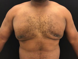 Gynecomastia