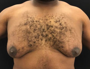 Gynecomastia