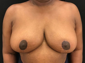 Breast Reduction