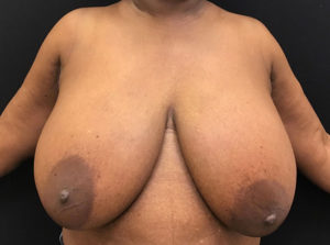 Breast Reduction