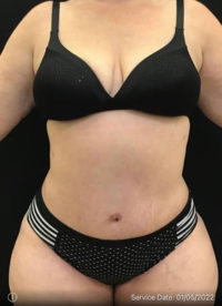 Tummy Tuck