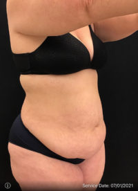 Tummy Tuck