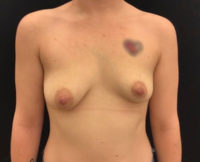 Breast Augmentation