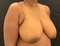 Breast Reduction