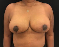 Breast Reduction