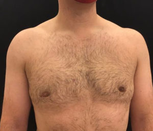 Gynecomastia