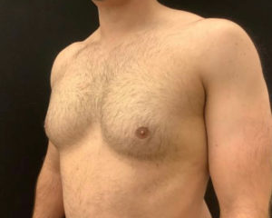 Gynecomastia