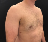 Gynecomastia