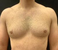 Gynecomastia