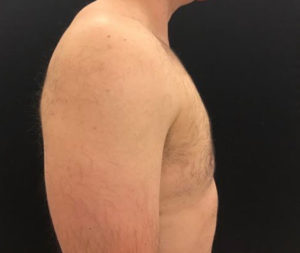 Gynecomastia