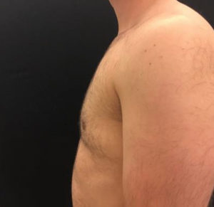 Gynecomastia